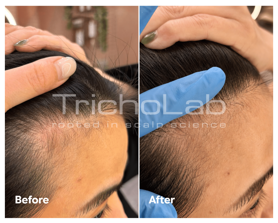 Before and after DEP Silk Hair Booster Treatment: fuller hair density at a TrichoLab client’s temple
