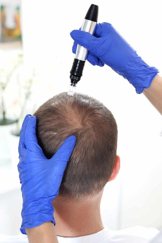 Here's How Microneedling Could Destroy Your Hair - TrichoLab