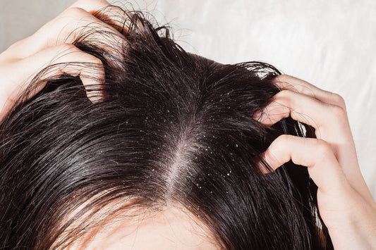 5 Common Questions About Dandruff: Our Experts Weigh In