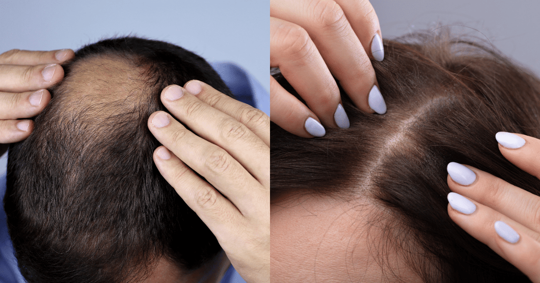 Male vs Female Hair Loss: Differences & Treatment Options