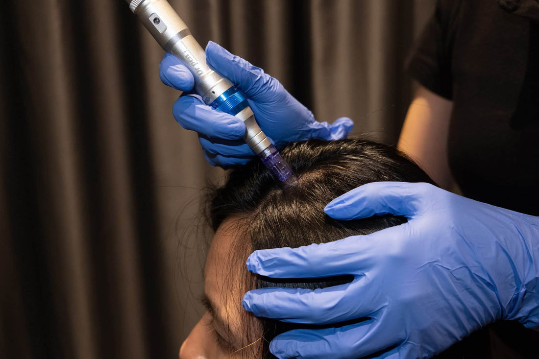 9 Things to Avoid After a Hair Loss Microneedling Treatment