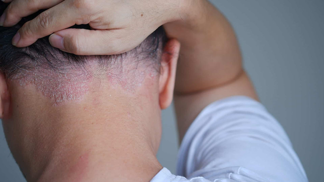 Scalp Psoriasis Treatment in Singapore: What Really Works?