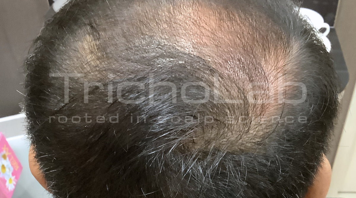 The same crown with visibly denser coverage after a TrichoLab microneedling programme