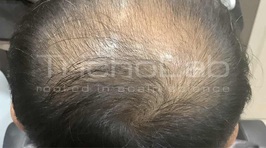 Crown with advanced thinning and visible scalp, before treatment
