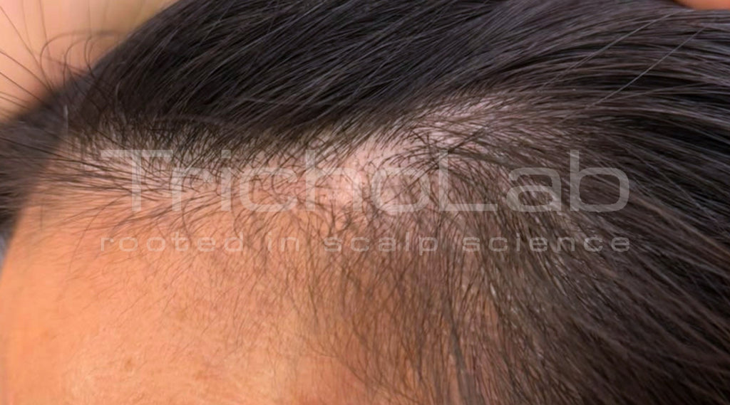 The same hairline with denser coverage after DEP Silk Hair Booster treatment