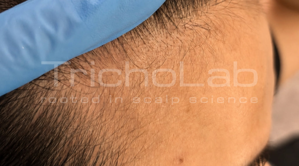 The same temple with fuller hair after DEP Silk Hair Booster treatment