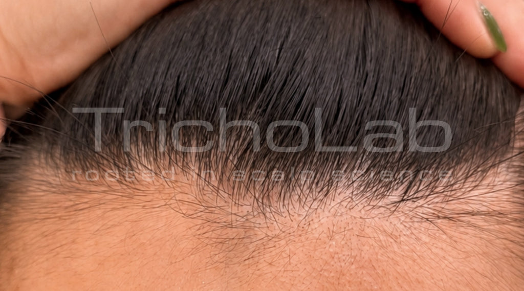 Thin, sparse front hairline, before DEP Silk