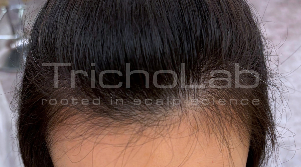 The front of the same scalp with thicker hair after a TrichoLab microneedling programme