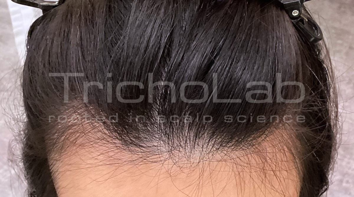 Thinning hair at the front of the scalp, before treatment