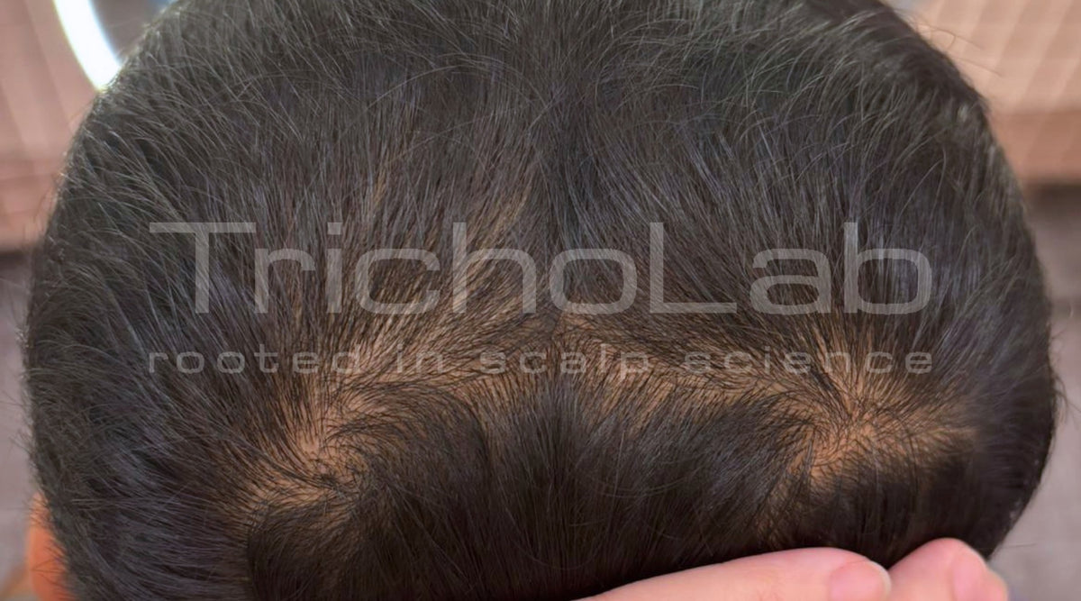 The top of the same scalp with fuller coverage after a TrichoLab microneedling programme