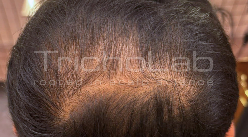 Thinning across the top of the scalp, before treatment