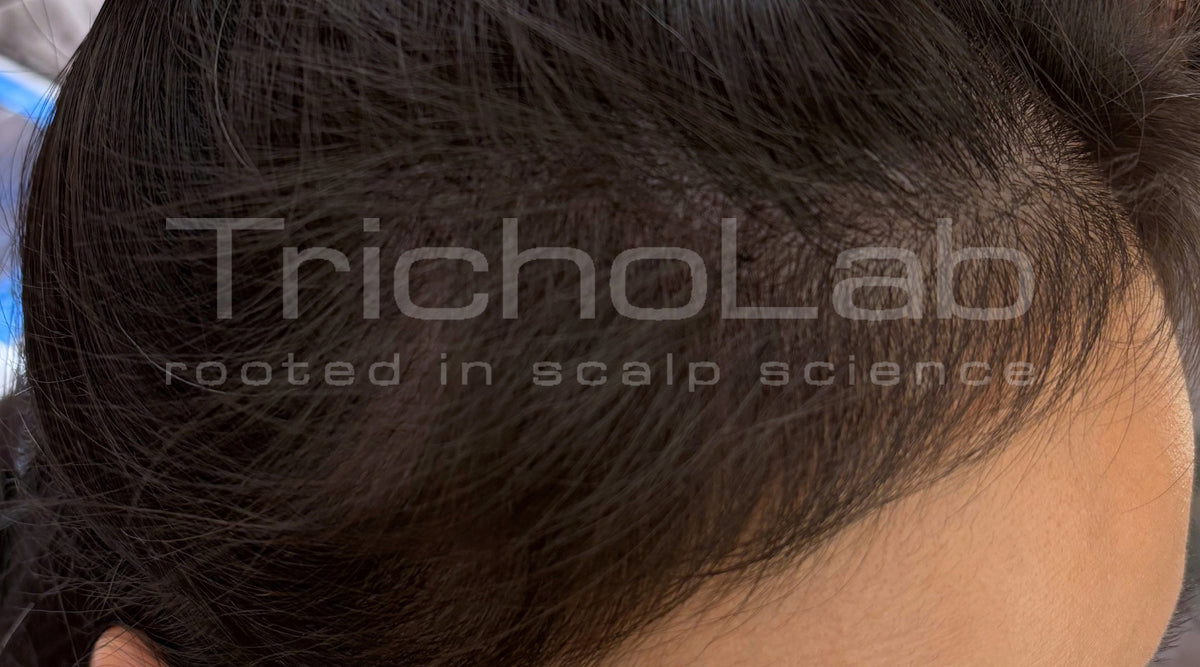 The same temple with visible regrowth after a TrichoLab microneedling programme