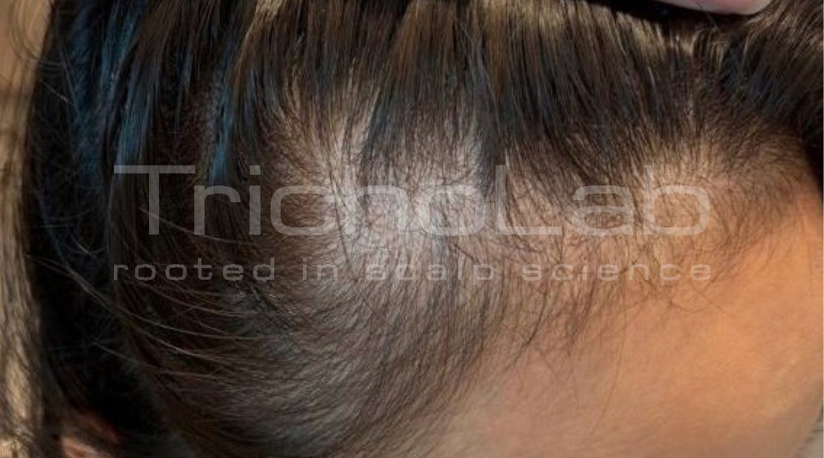 Thinning at the temple after childbirth, before treatment