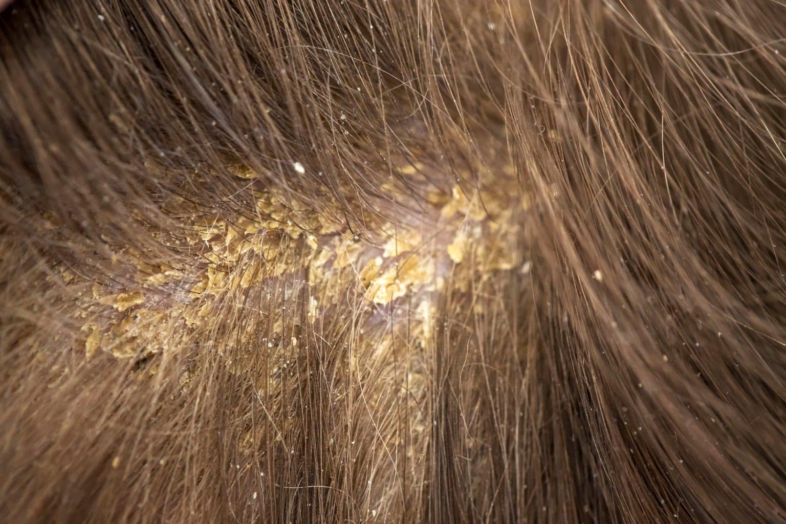 3 Common Scalp Disorders | TrichoLab