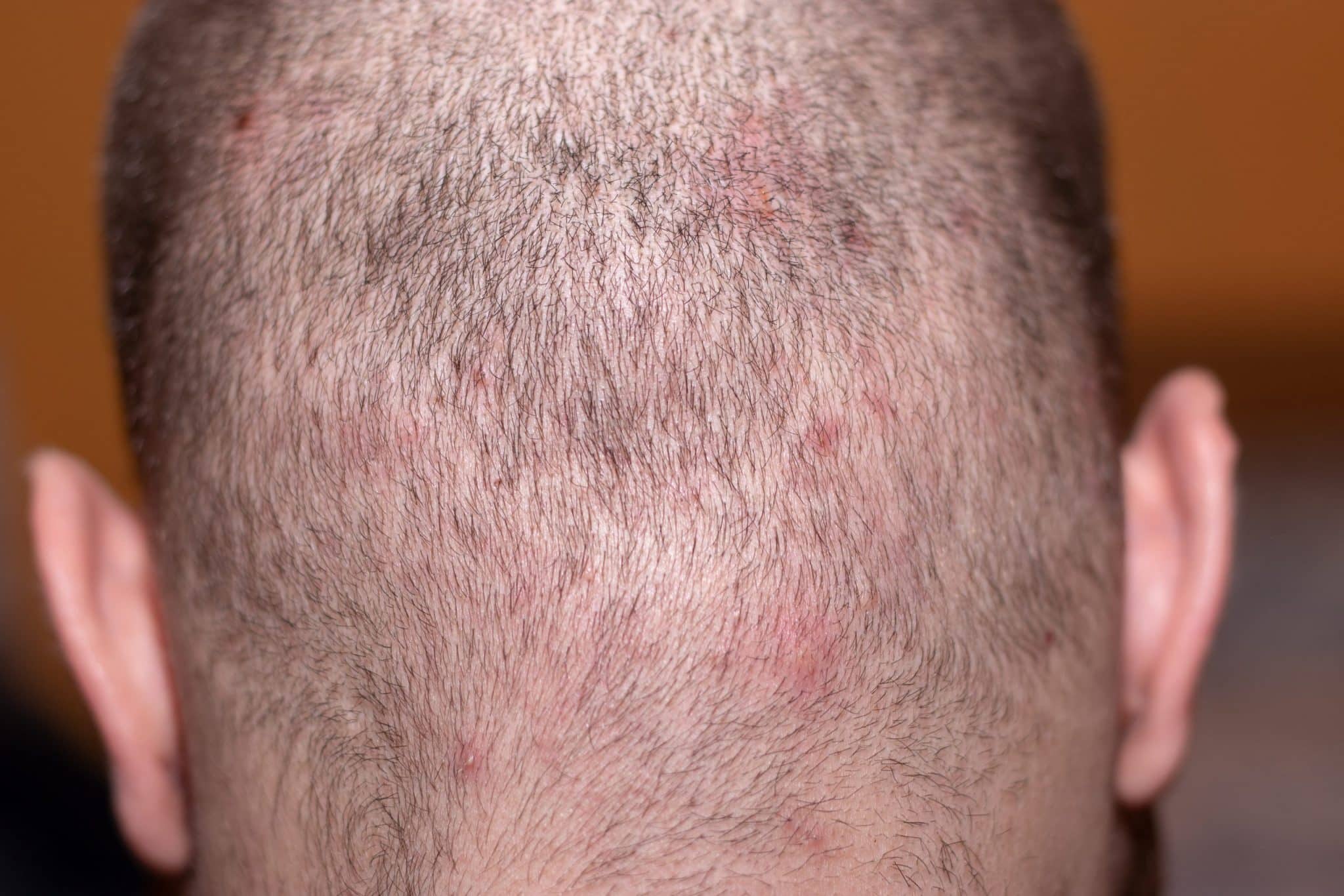 Scalp Folliculitis Cure Folliculitis Decalvans