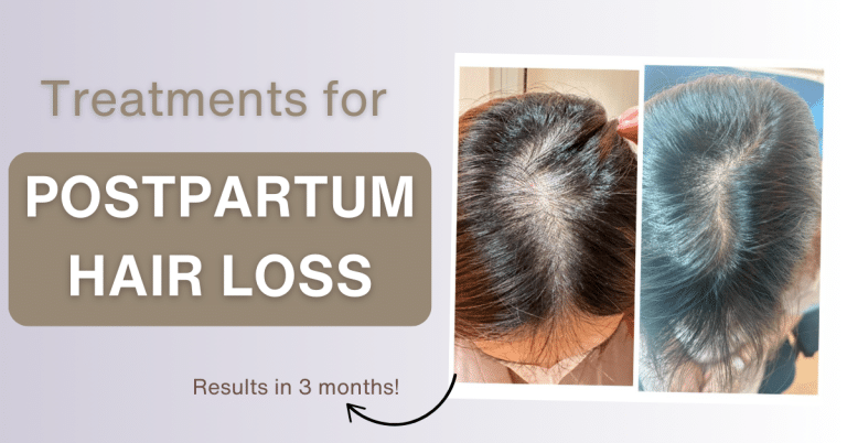 postpartum hair loss treatment options