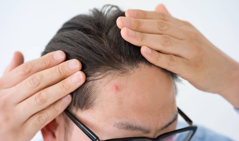 scalp pimple & scalp acne treatment
