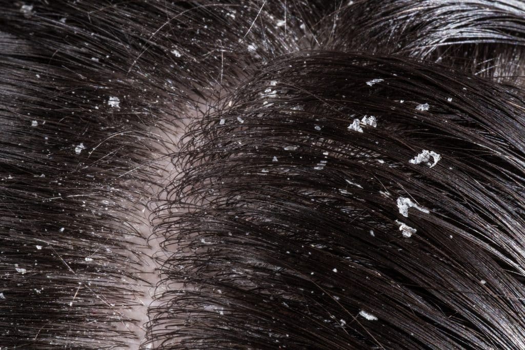 Close-up view of white dandruff flakes on scalp.