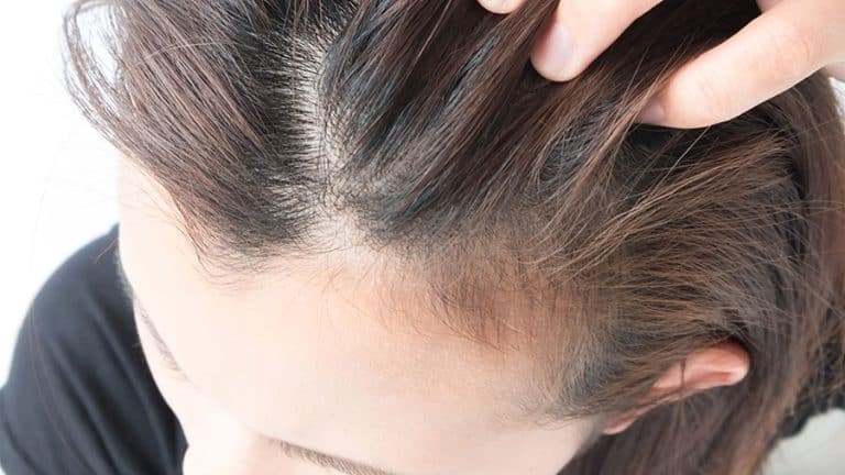 A woman with thinning hair on her scalp.