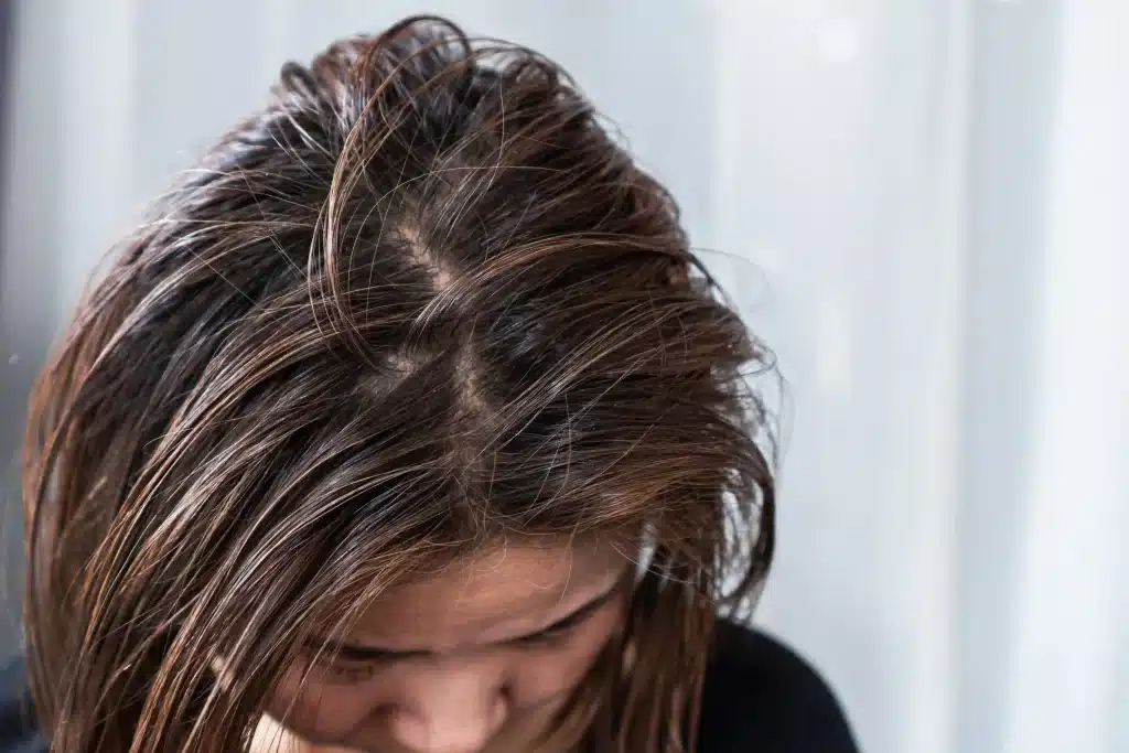 Woman with oily hair
