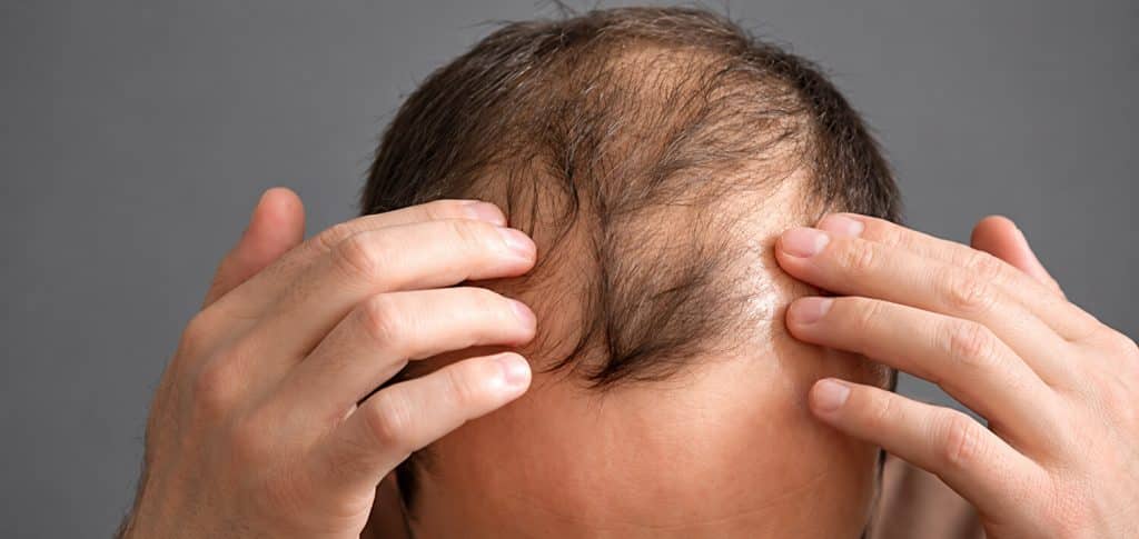 Saw Palmetto vs Minoxidil for Hair Loss: Which Works Better?